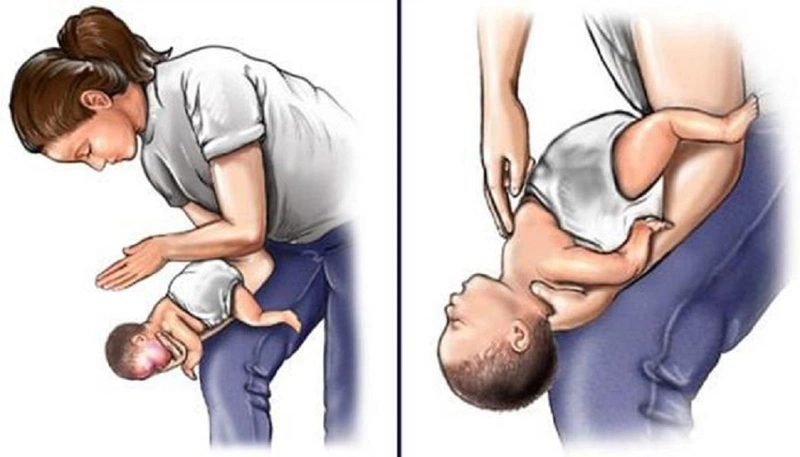 Xử Trí Dị Vật Đường Thở (Hóc Dị Vật) Ở Người Lớn Và Trẻ Em