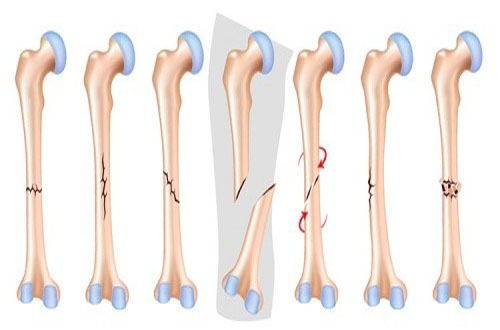Sơ Cứu Gãy Xương – Làm Gì Khi Nghi Ngờ Bị Gãy Tay, Chân?