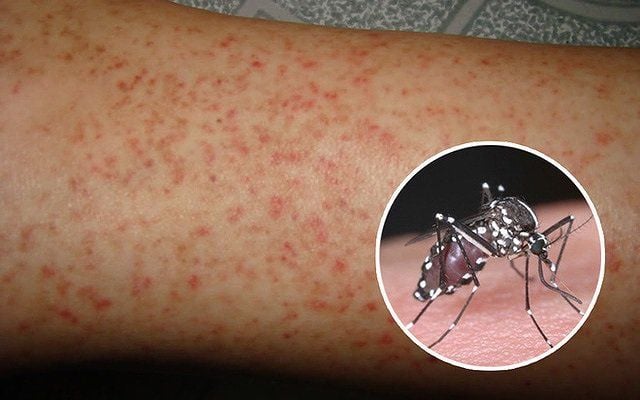 Sốt Xuất Huyết: Dấu Hiệu Nhận Biết & Cách Phòng Tránh Hiệu Quả